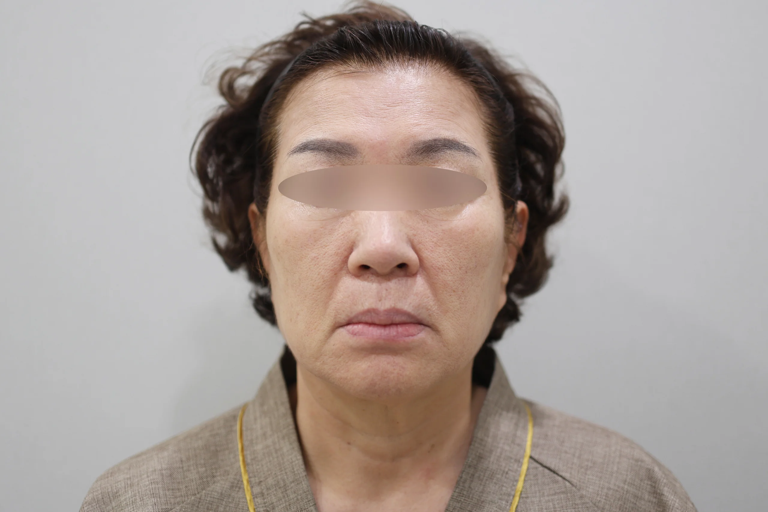 세르프제로 시술 전 정면 사진 3번