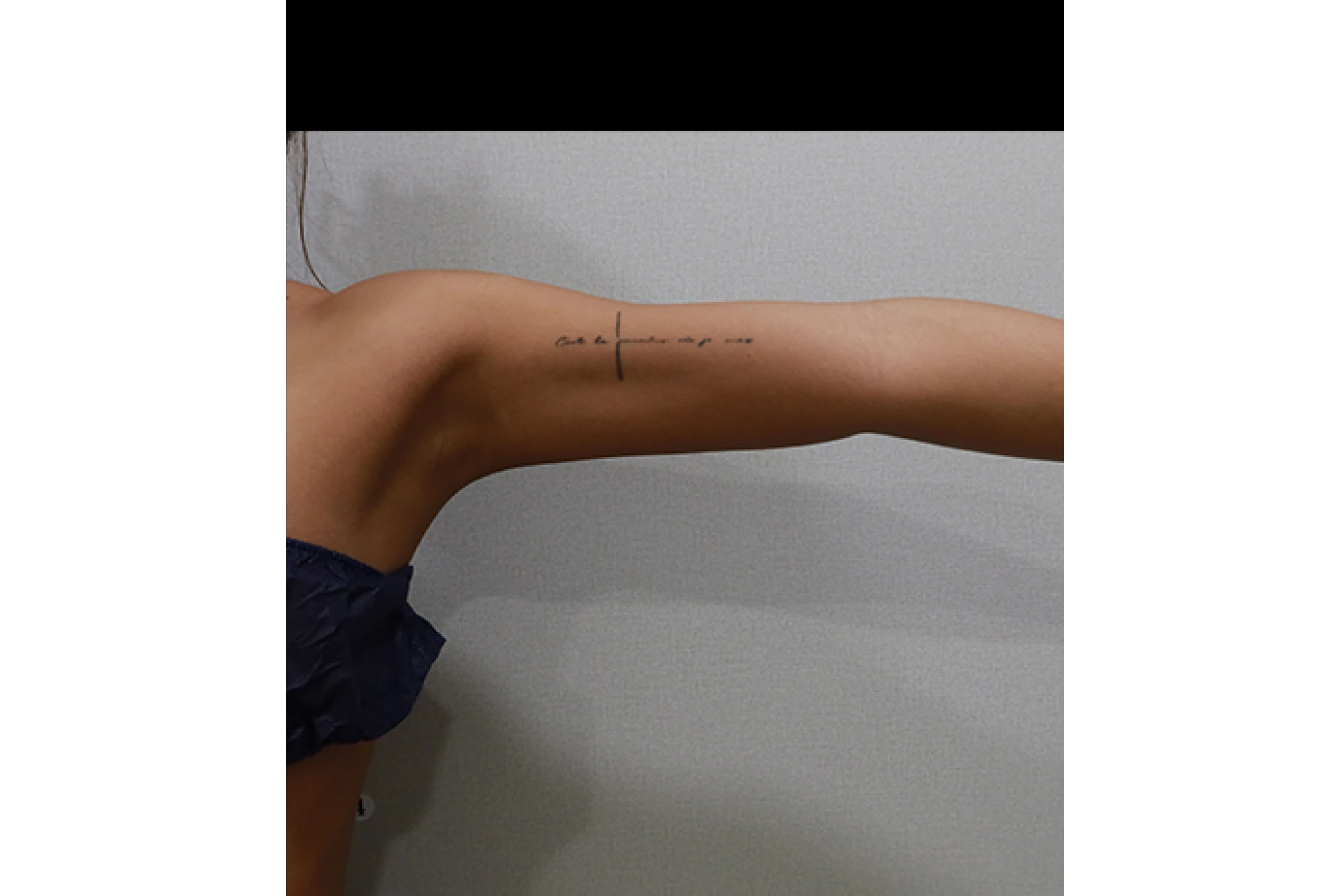 바디 티타늄 레이저 시술 후 측면 04