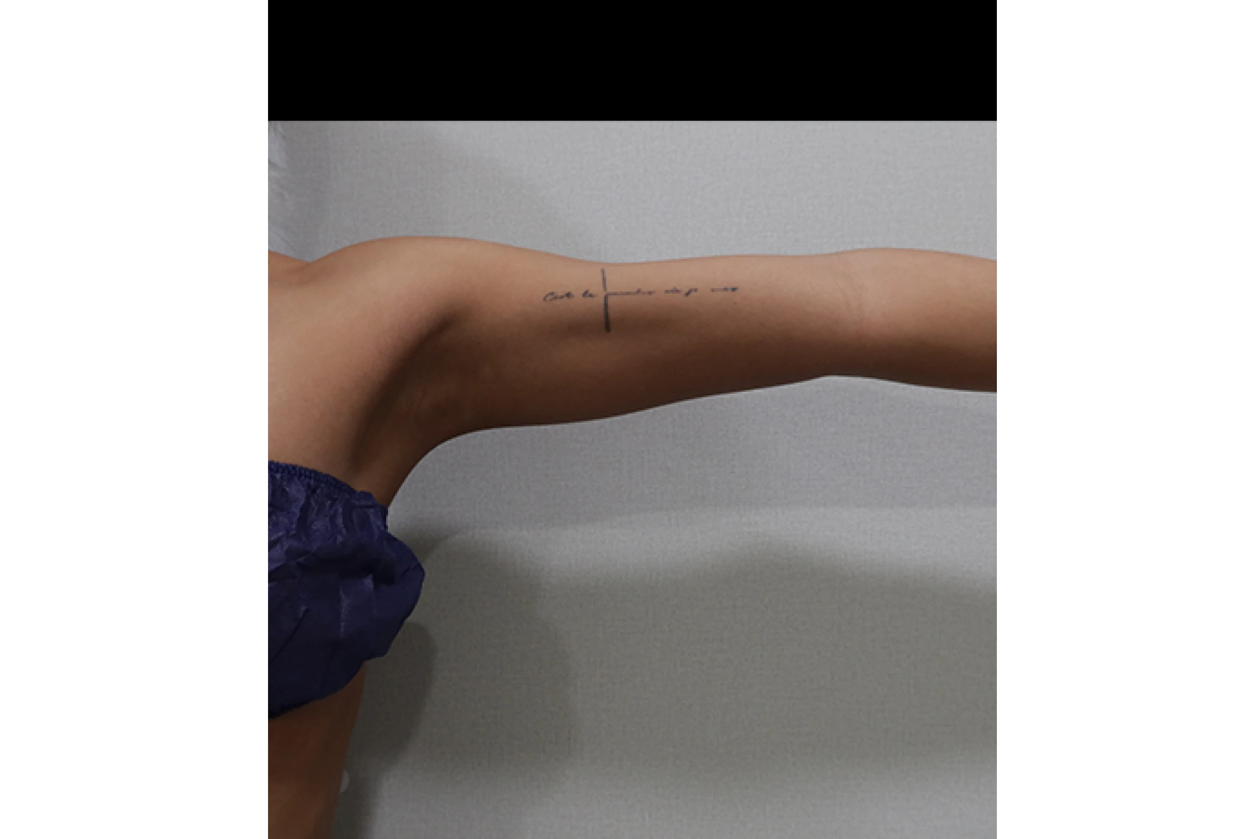 바디 티타늄 레이저 시술 전 측면 04