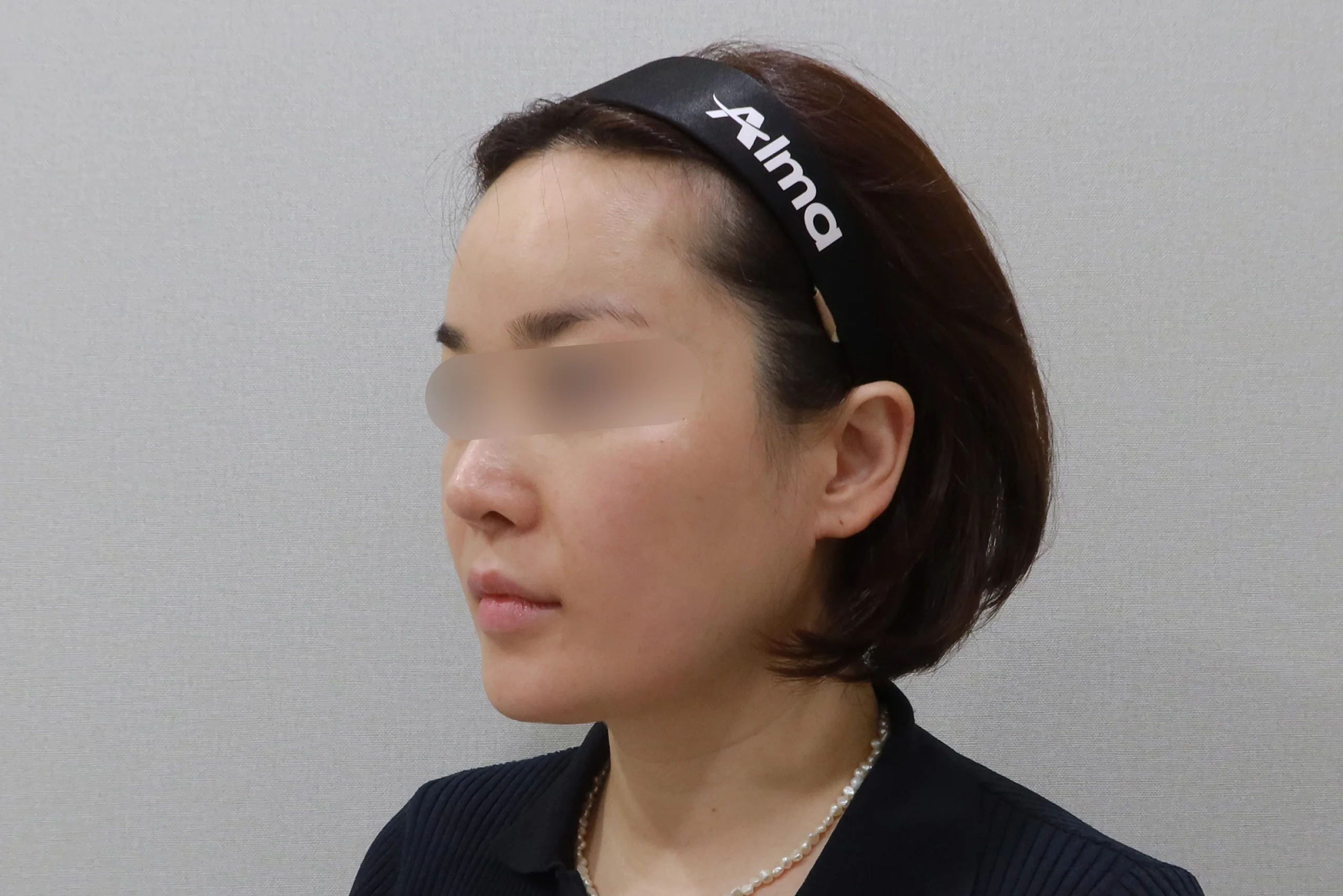 얼굴살 지우개 주사 후 측면 사진 4