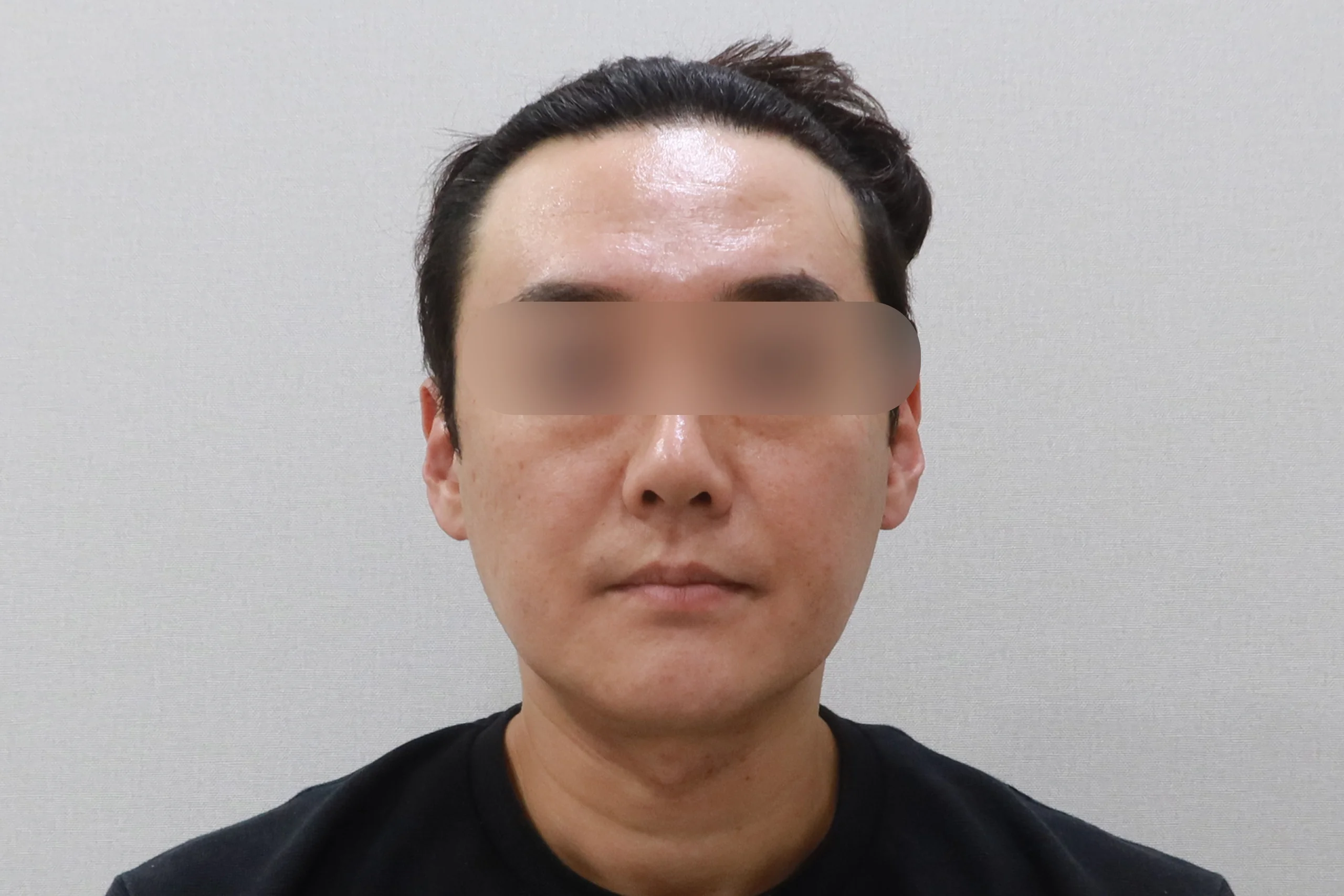 얼굴살 지우개 정면 전