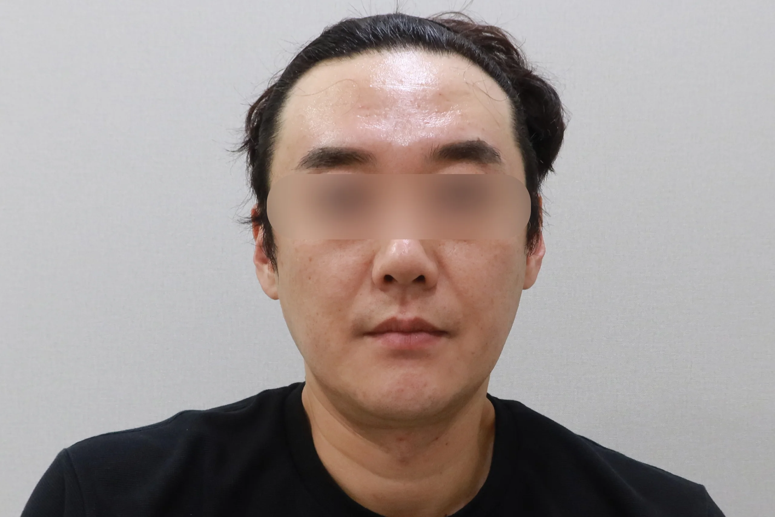 얼굴살 지우개 정면 후