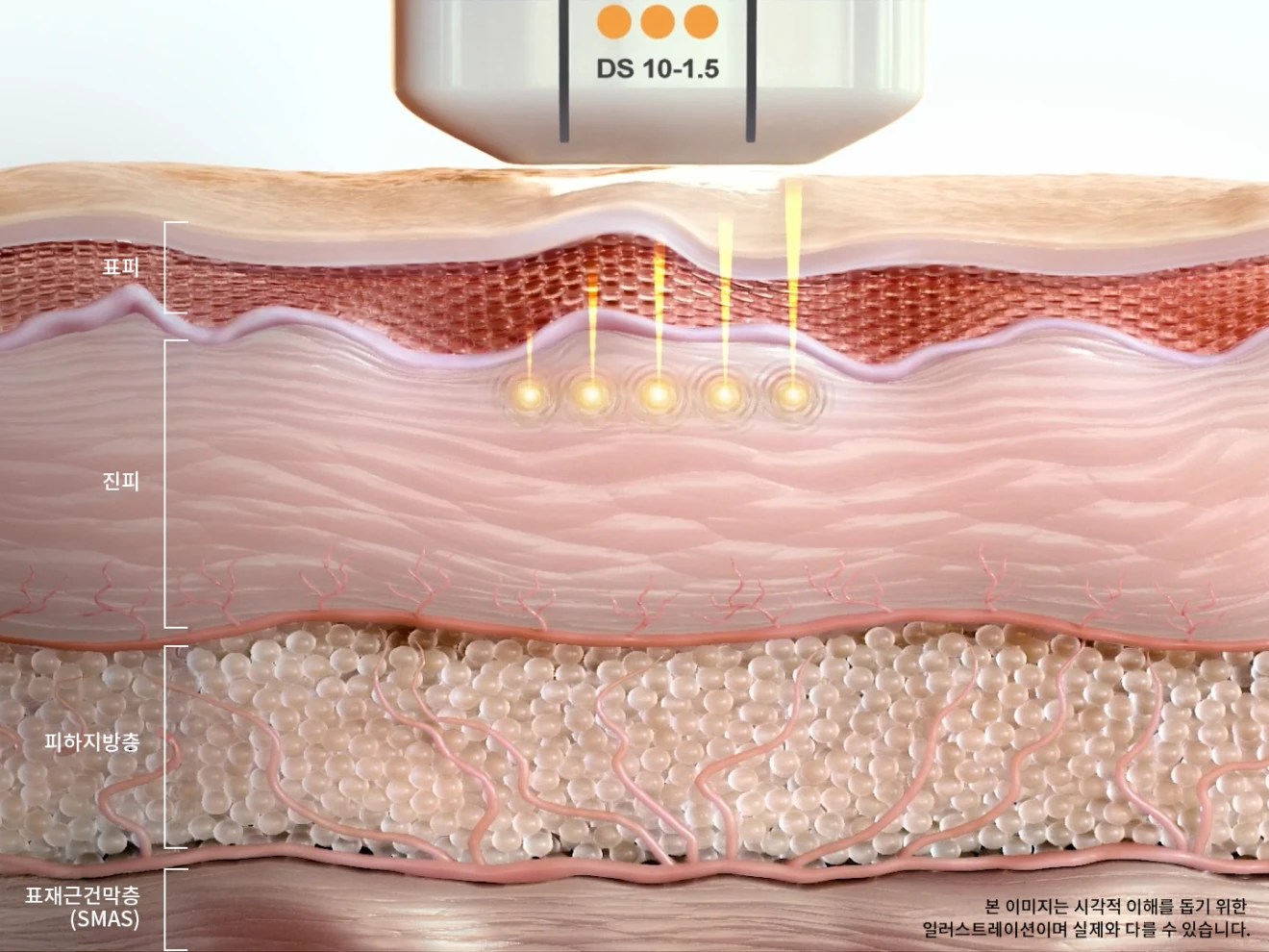 울쎄라피 프라임 1.5mm 카트리지 진피 표층 작용 단면도